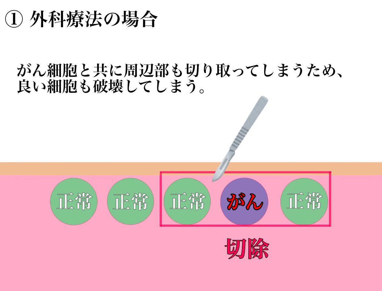 ①外科療法