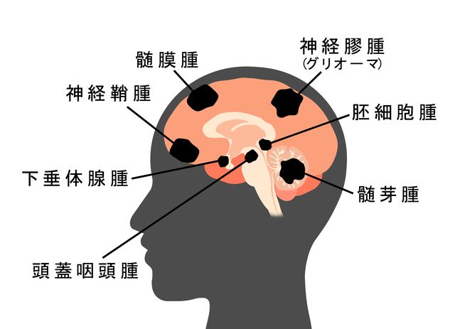 脳腫瘍の種類