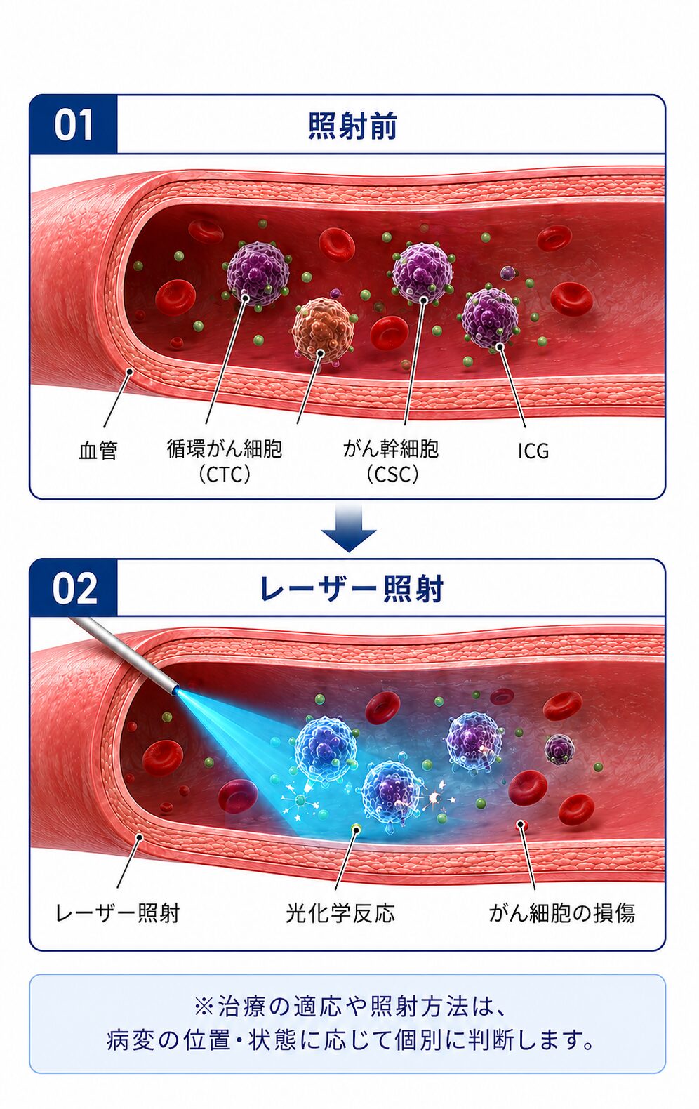 血管内治療における照射前とレーザー照射時の模式図